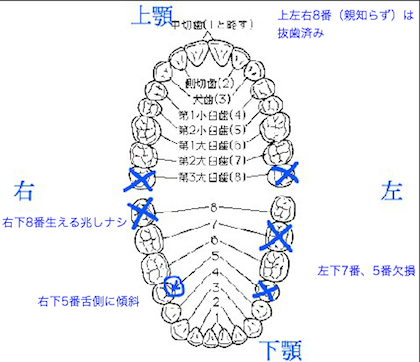 2015:12:30まとめ記事用 歯の図 その2